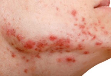 acné hormonal